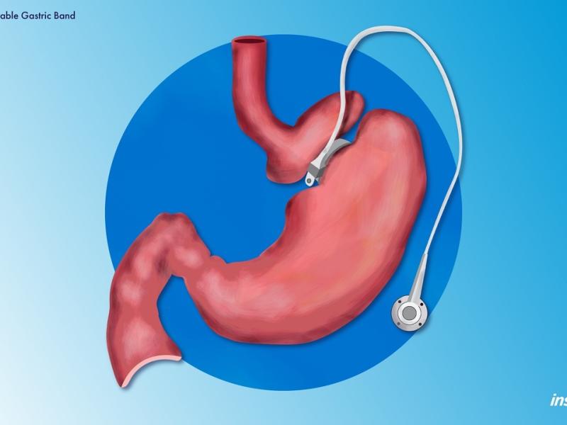 Bariatric Services and Surgery Inspira Health